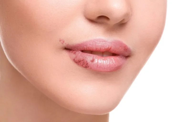 Herpes labial