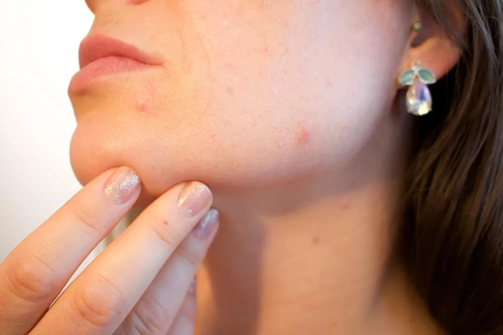 alguns cosméticos usados para tratar a acne usam o zinco para amenizar a inflamação local