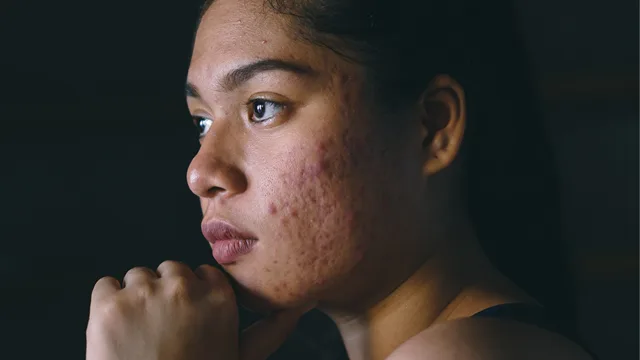 dependendo da gravidade da acne, as cicatrizes surgem sem uma causa direta