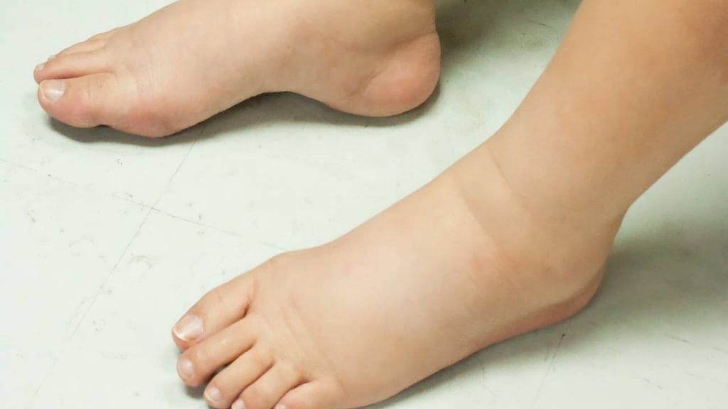 Pessoa com os pés apoiados ao chão, apresentando edema na região.