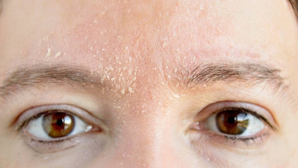 Na imagem, o rosto de uma pessoa com dermatite seborreica na pele entre as sobrancelhas e olhos.