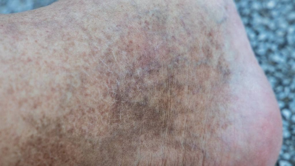 Na imagem, uma mancha marrom no tornozelo é o sintoma da dermatite ocre.