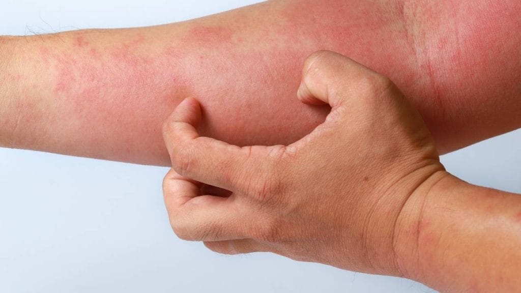 Pessoa coçando braço irritado com alergia.