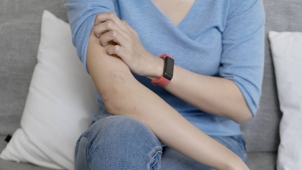 Mulher sentada, está coçando o braço como reação da pele seca.