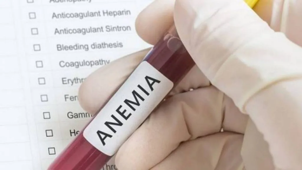 Na imagem uma pessoa segura um tubo de coleta com, aparentemente, sangue. Nele, uma etiqueta está escrito anemia, considerada uma das doenças que causam a queda de cabelo, pela baixa quantidade de vitaminas no organismo.