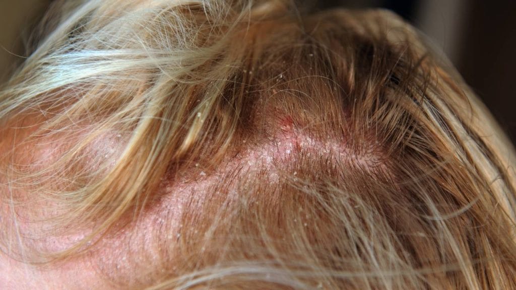 Na imagem, a parte superior da cabeça de uma pessoa, demonstrando a reação da dermatite seborreica, doença que causa a que da de cabelo. Percebe-se descamação, vermelhidão e feridas no couro cabeludo.