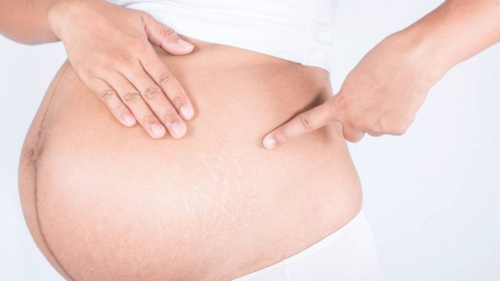 Mulher indicando estrias em sua barriga que apareceram durante a gestação.