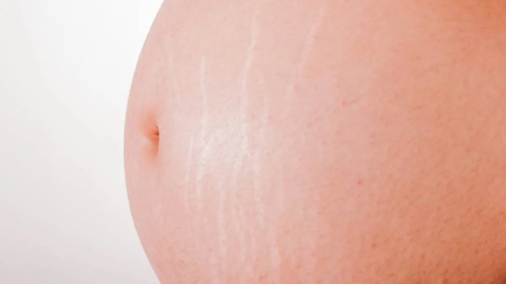 Estrias gestacionais podem ser evitadas utilizando os produtos que hidratam e favorecem a restauração da pele.