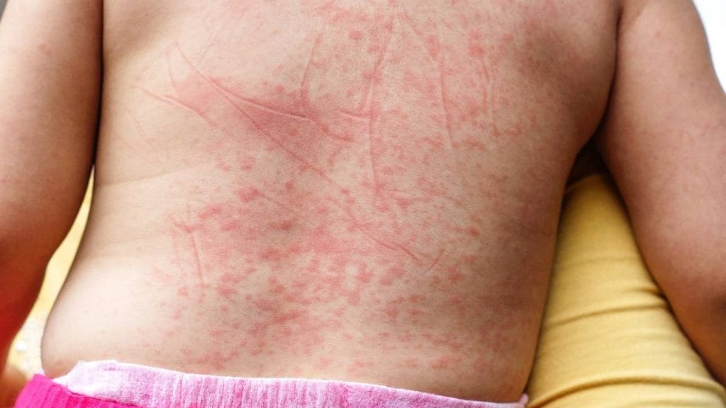 Um dos principais sintomas da dengue em crianças são as manchas avermelhadas na pele.