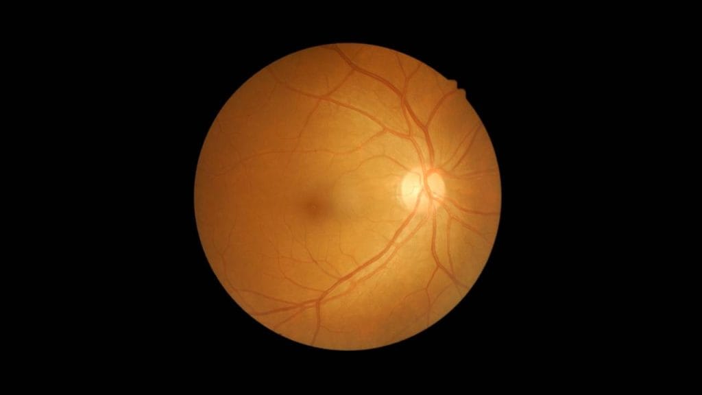 A retinopatia diabética é a causa mais comum de perda de cisão em pacientes com diabetes.