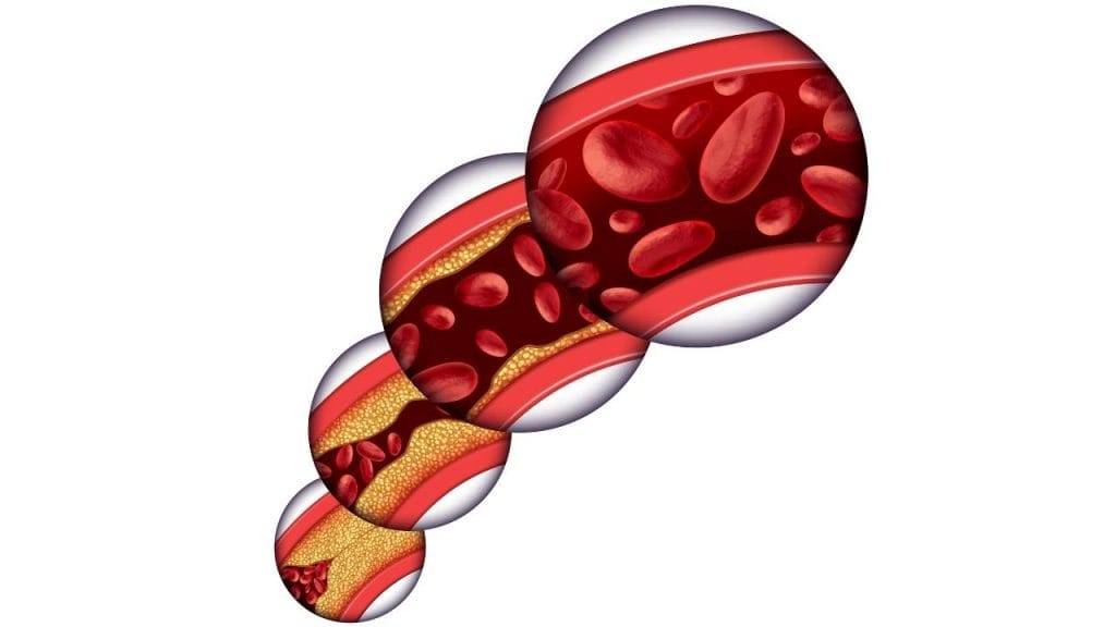 Imagem ilustrativa de uma artéria que sofre com a ação do colesterol alto.