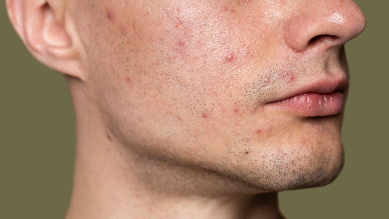 Saiba quais sãoa s principais doenças de pele no verão e como prevenir.