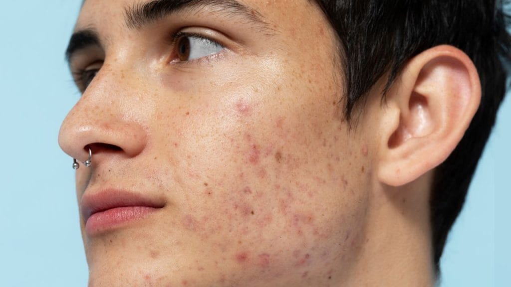 Manchas de acnes podem surgir com a exposição solar sem proteção.