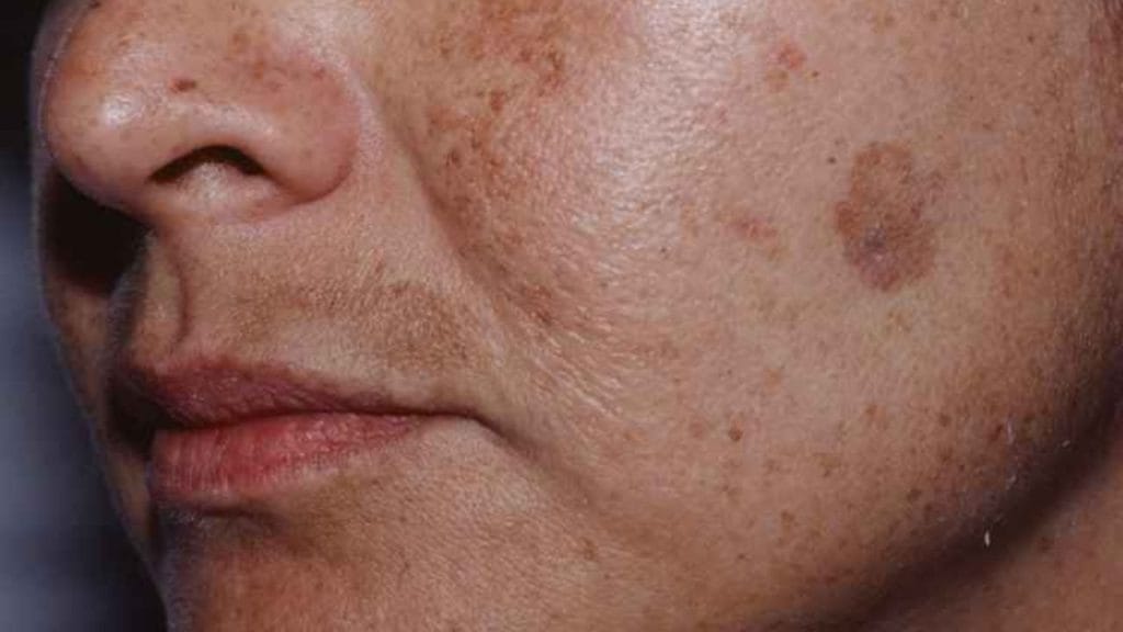 O melasma está relacionado principalmente à exposição solar e alterações hormonais.
