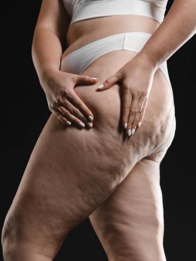 O que é lipedema nas pernas? Entenda as causas e sintomas