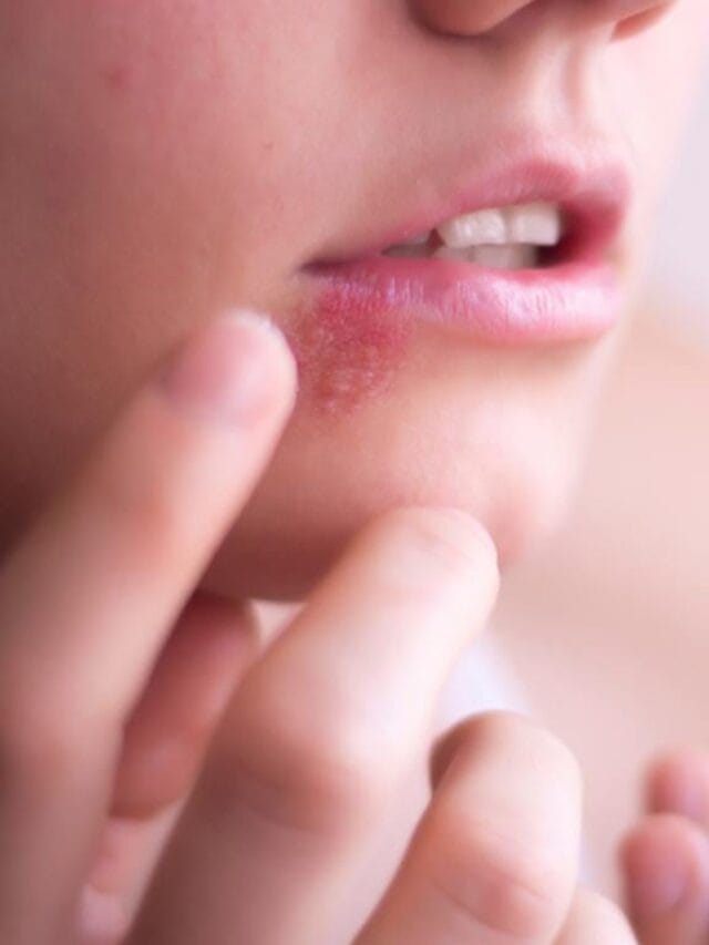 Para que serve Aciclovir? Entenda o que o medicamento e como usar