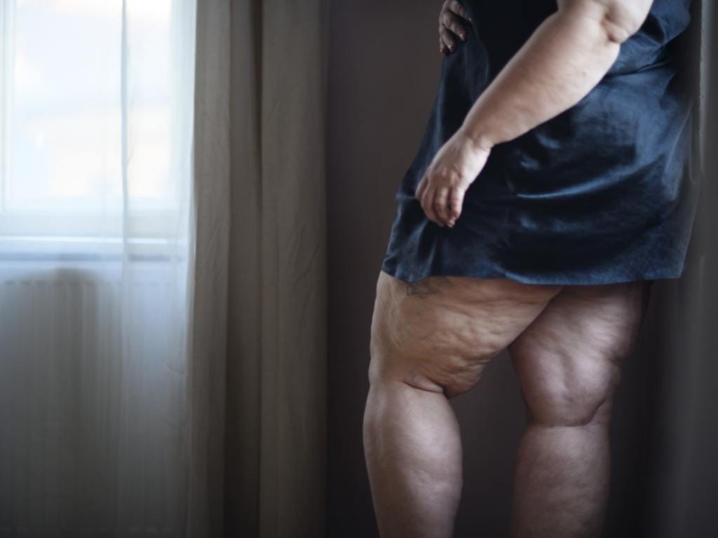 Acumulo de gordura na perna devido a lipedema
