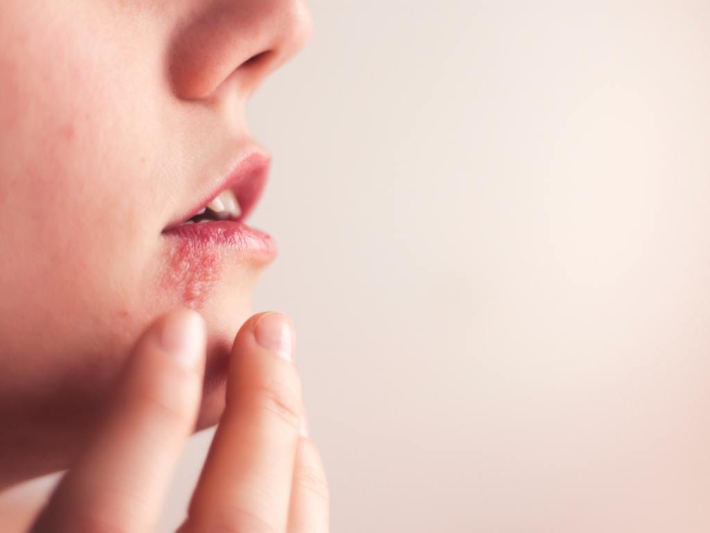 Mulher vendo feridas de herpes