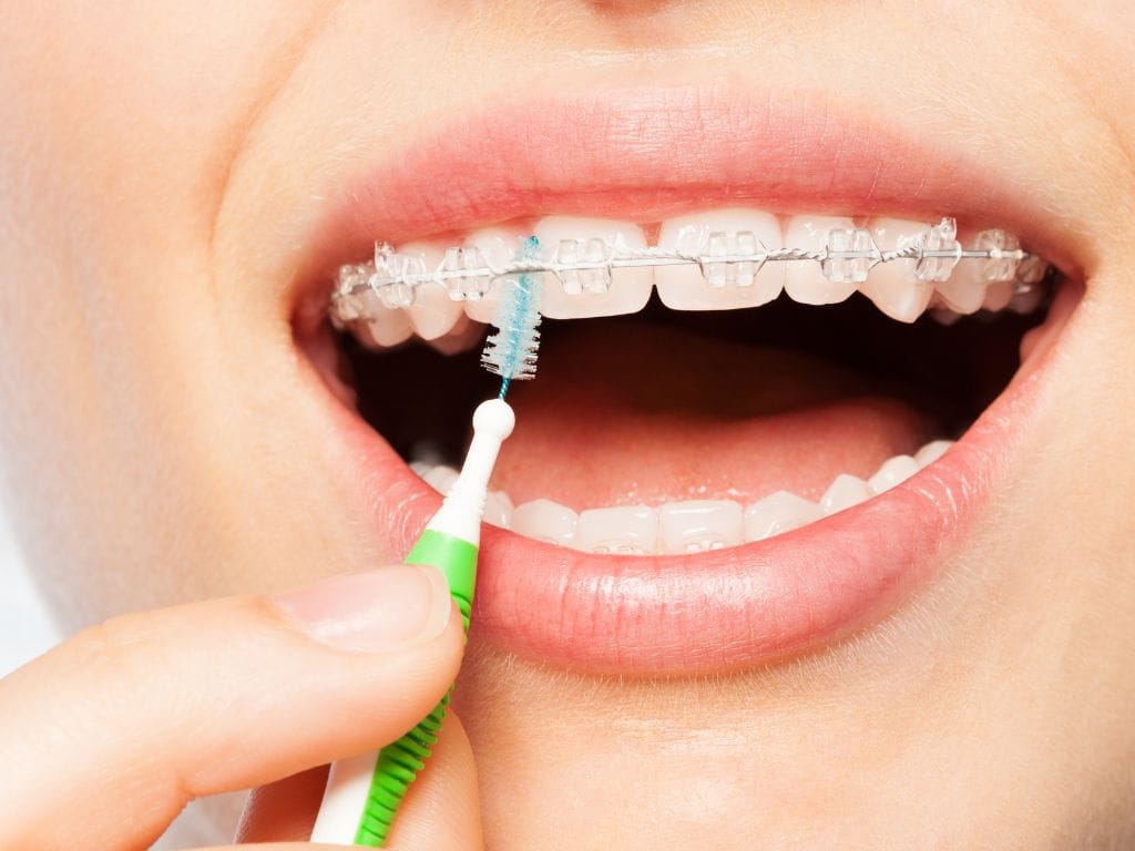 pessoa com aparelho usando escova interdental