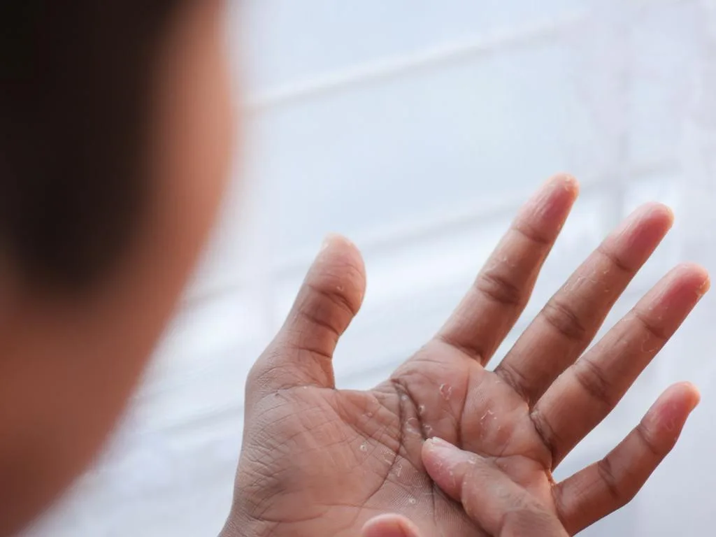 Pessoa coçando a mão com disidrose