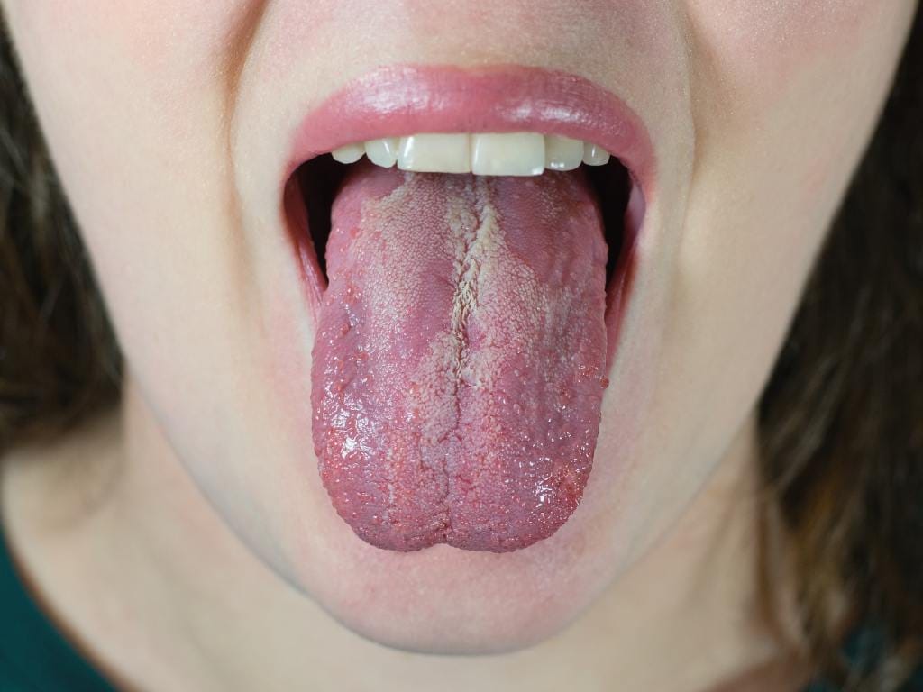 língua esbranquiçada, sinal de candidíase oral