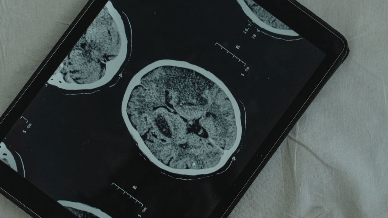 tomografia para diagnóstico de glioma