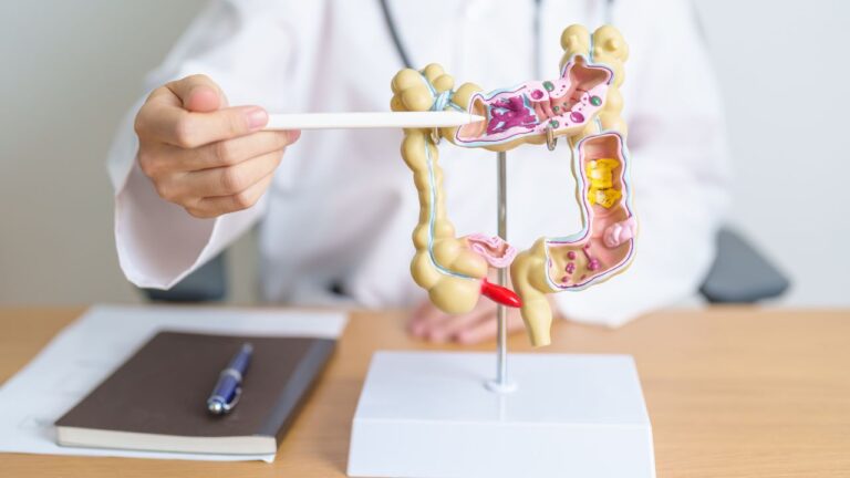 representação de intestino com diverticulite