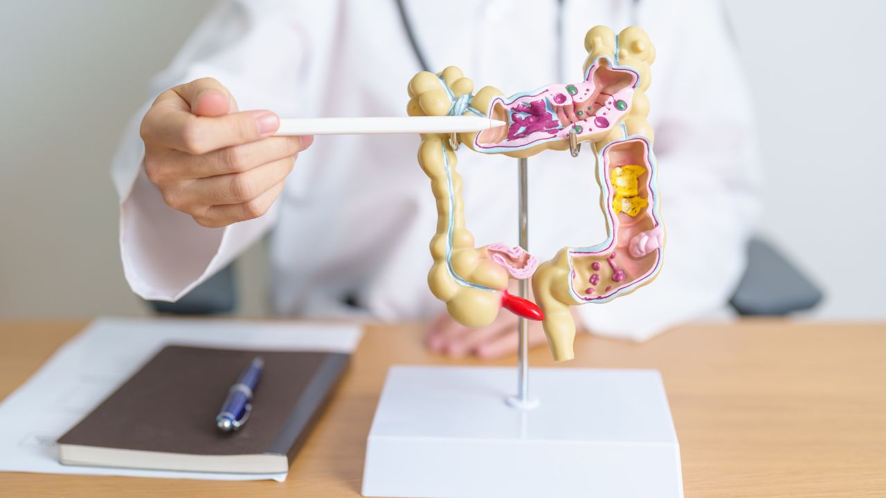 representação de intestino com diverticulite